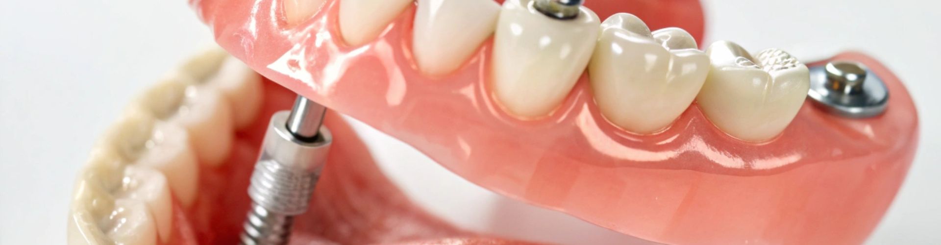 implantes de carga inmediata