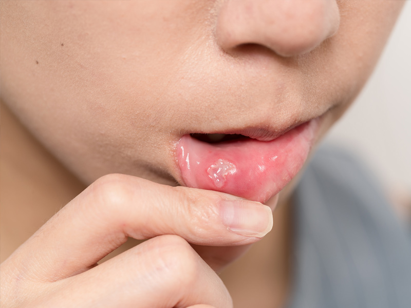 Bit Inside of Lip: How to Treat a Bite Inside Your Mouth