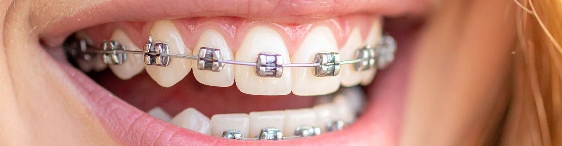 microtornillos en ortodoncia