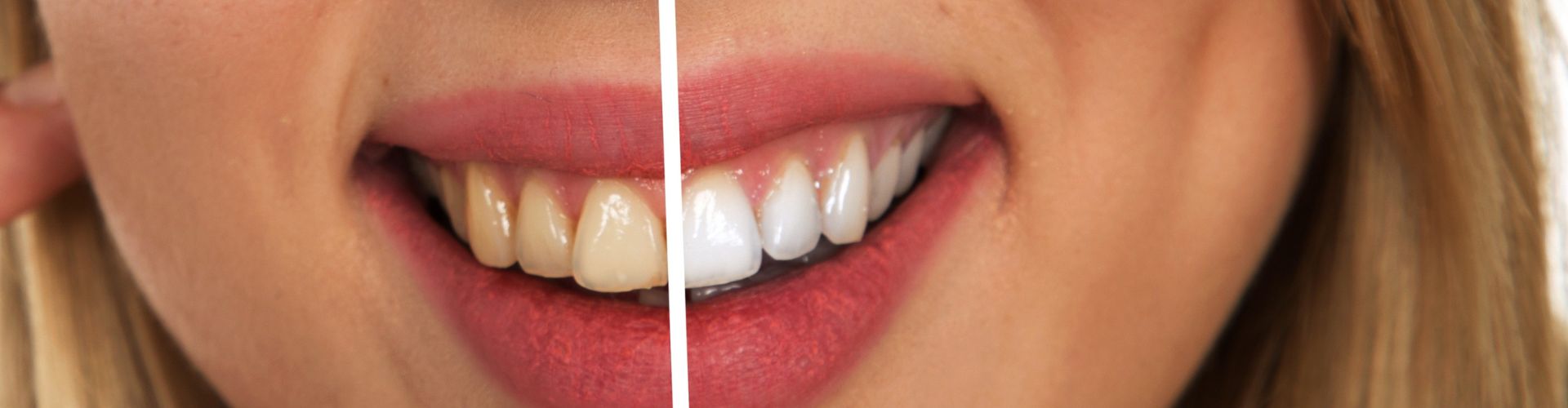 claves para un buen blanqueamiento dental
