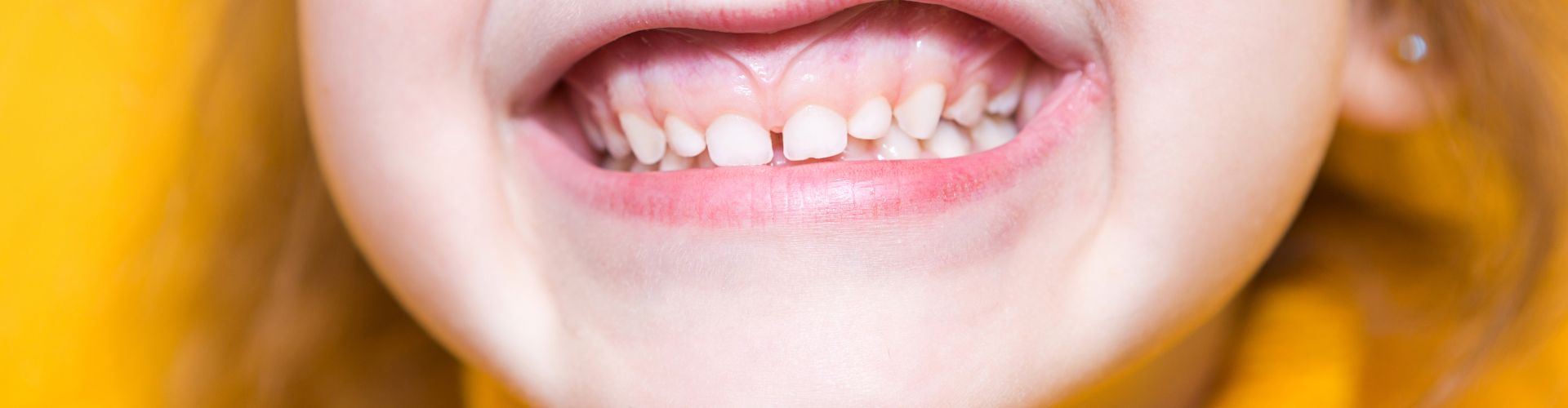 solucionar la sobremordida