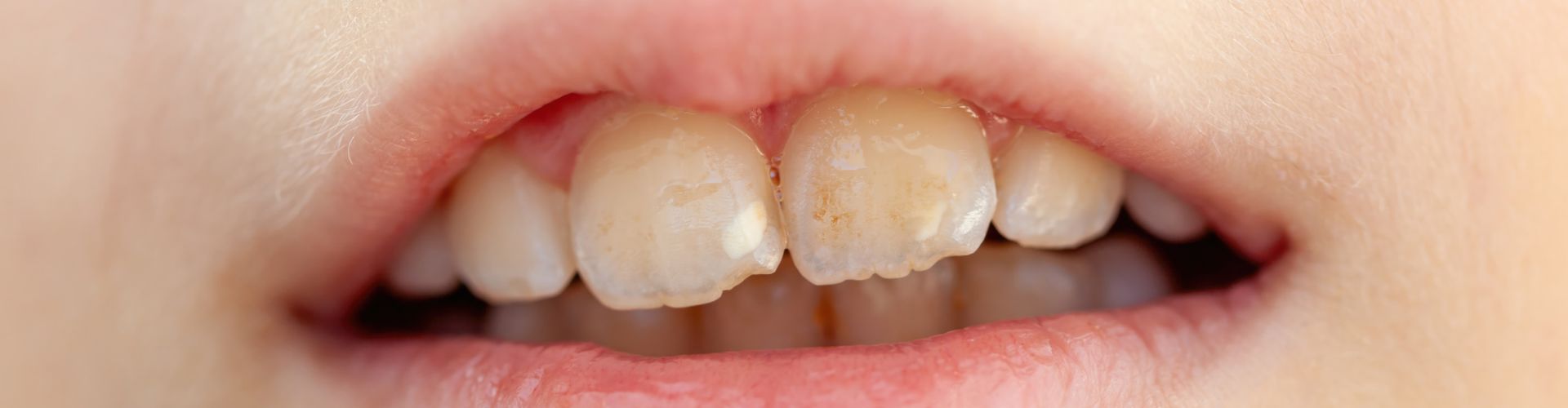 fluorosis