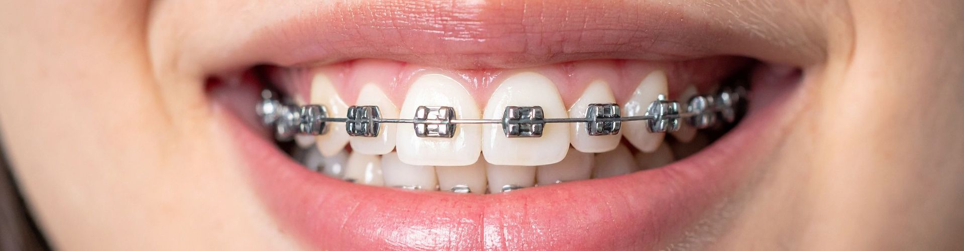 cuidar los dientes durante un tratamiento de ortodoncia