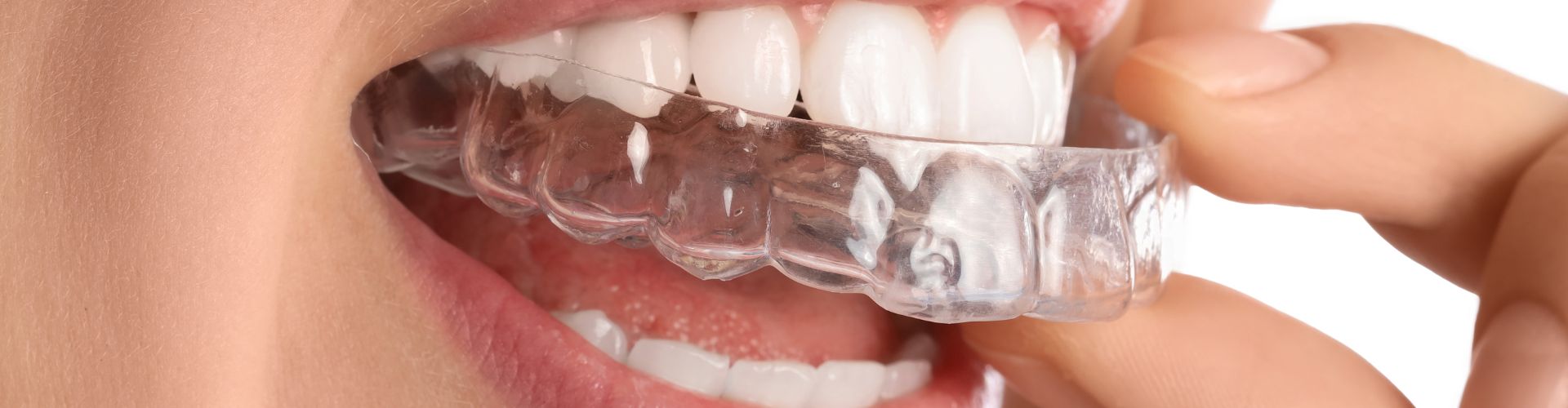 Alineadores invisibles
