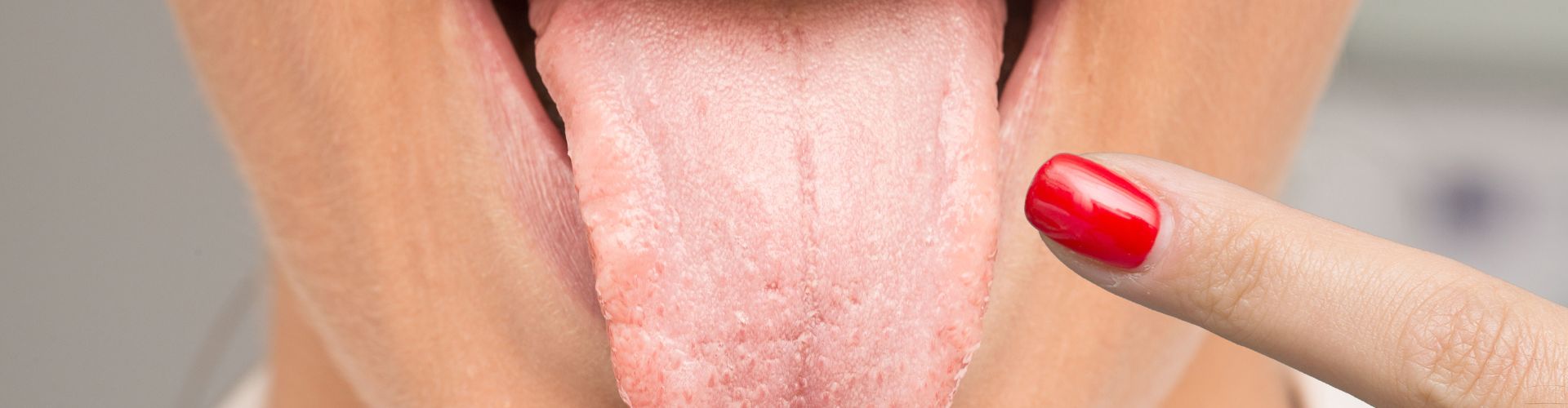 Candidiasis oral