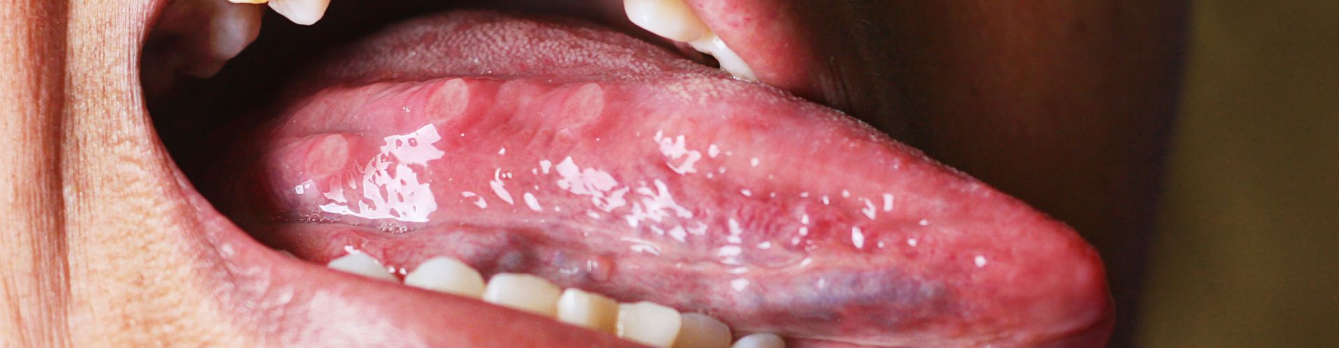 Inflamación debajo de la lengua