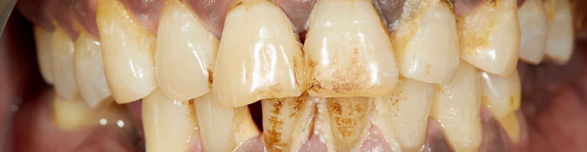 periodontitis avanzada