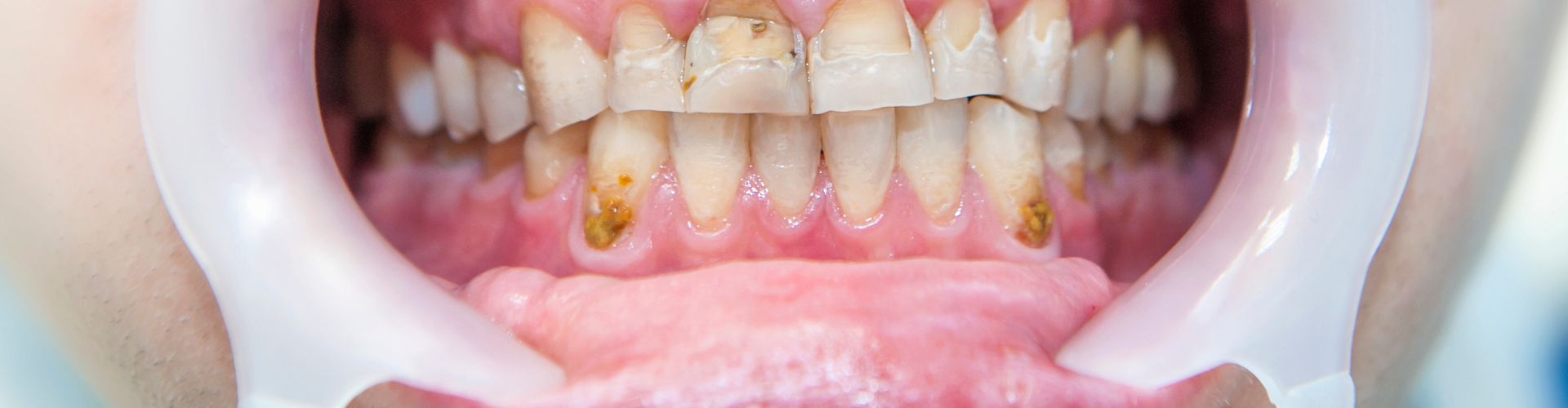 fluorosis