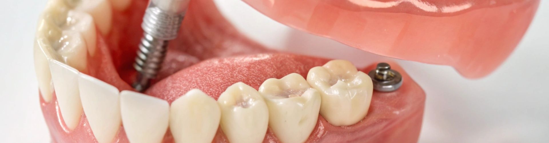 fases de los implantes dentales