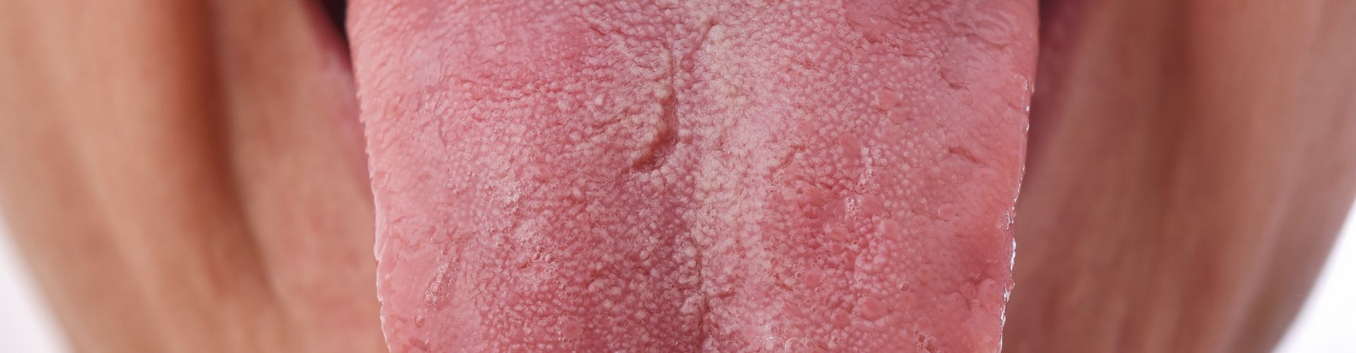 Grietas en la lengua