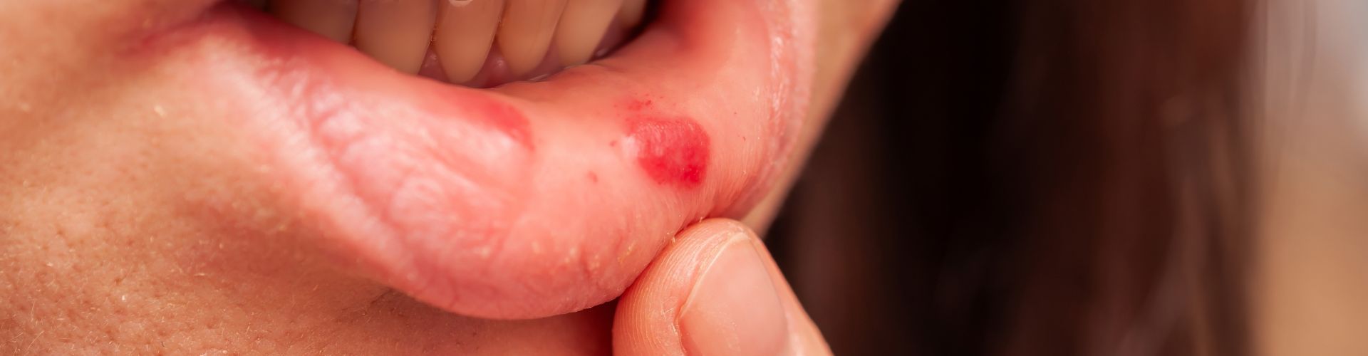 curar llagas boca