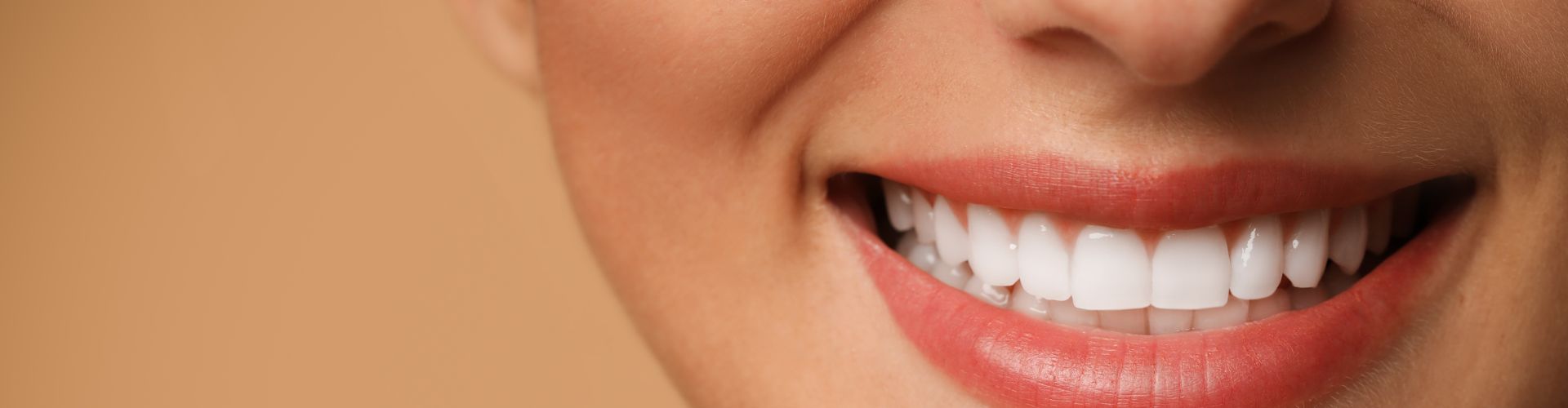 carillas dentales para bodas