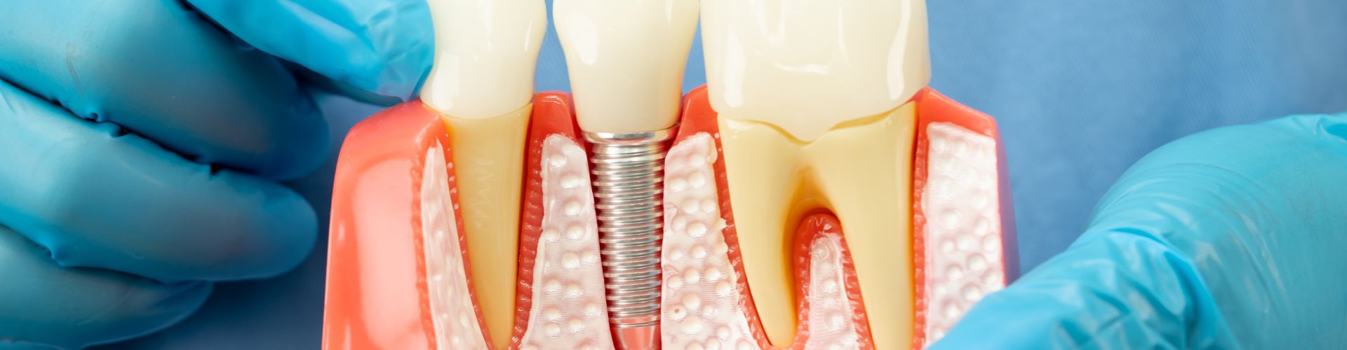 implantes si tengo hueso