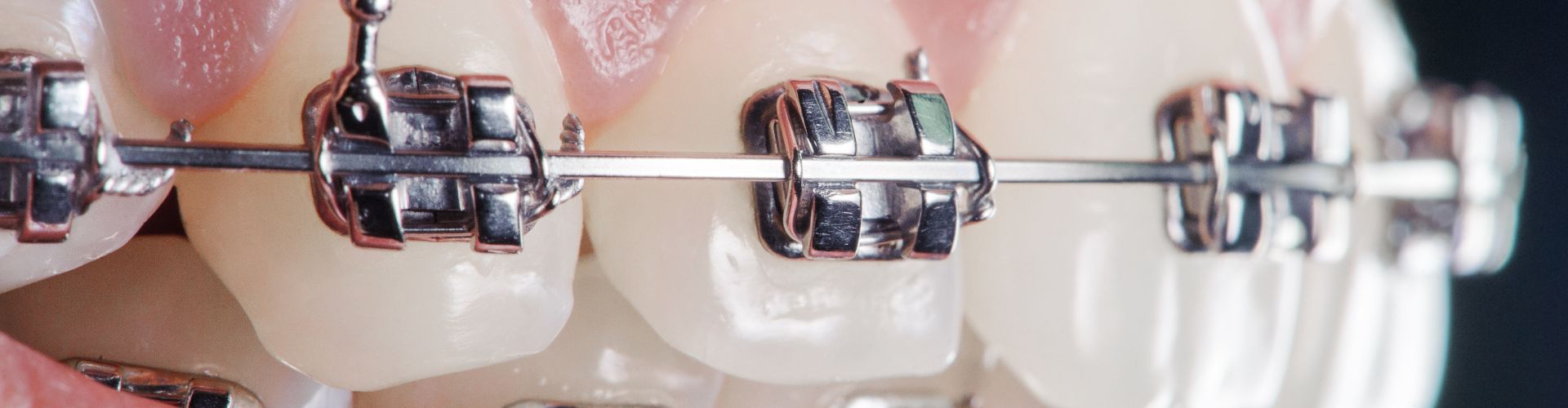 tratamiento de ortodoncia