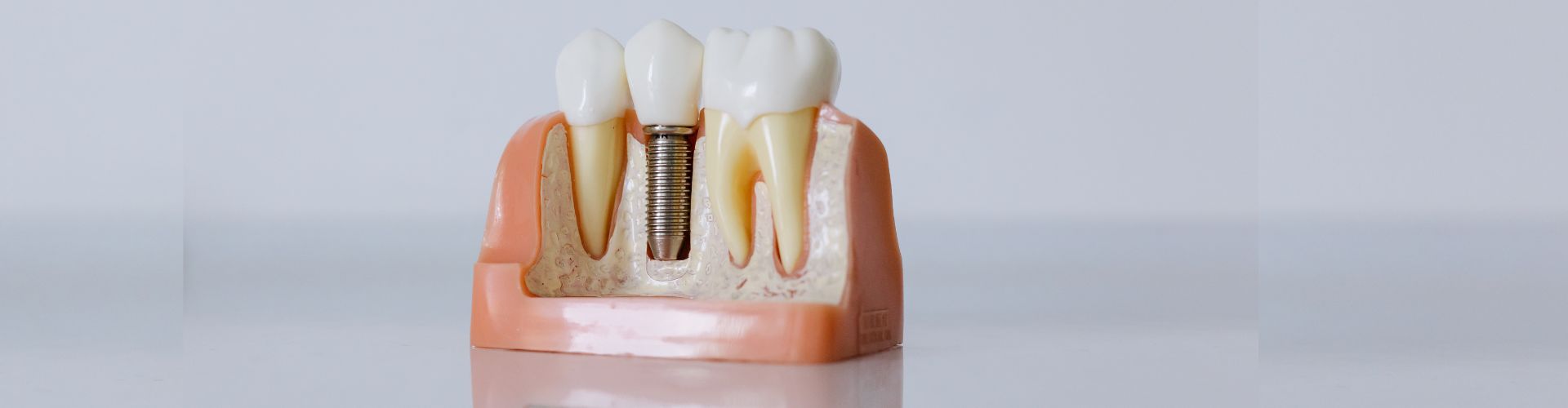 recuperacion tras implantes dentales