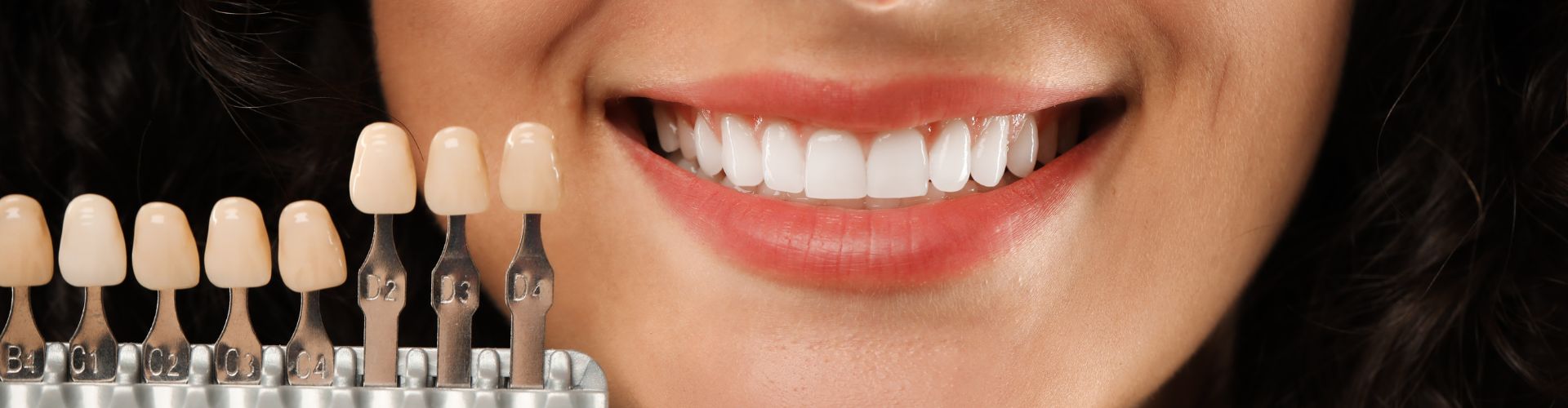 cuanto duran las carillas dentales