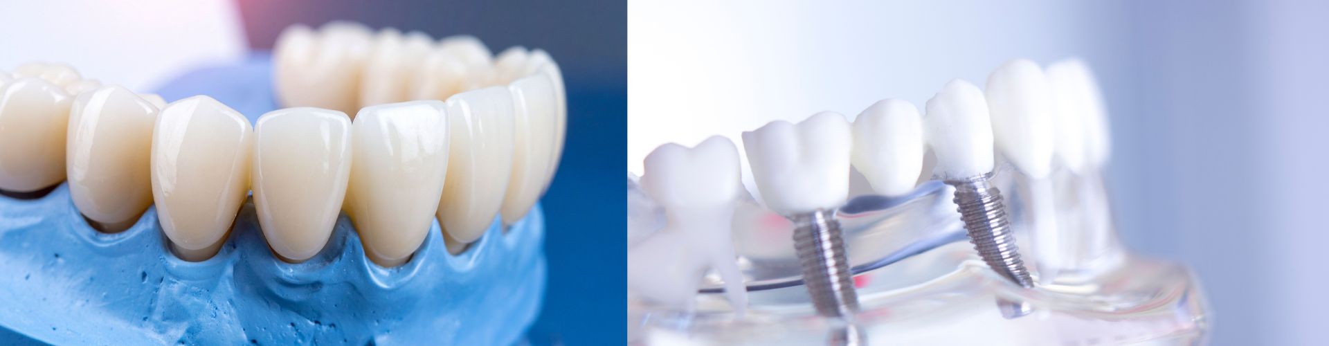 implante o puente dental