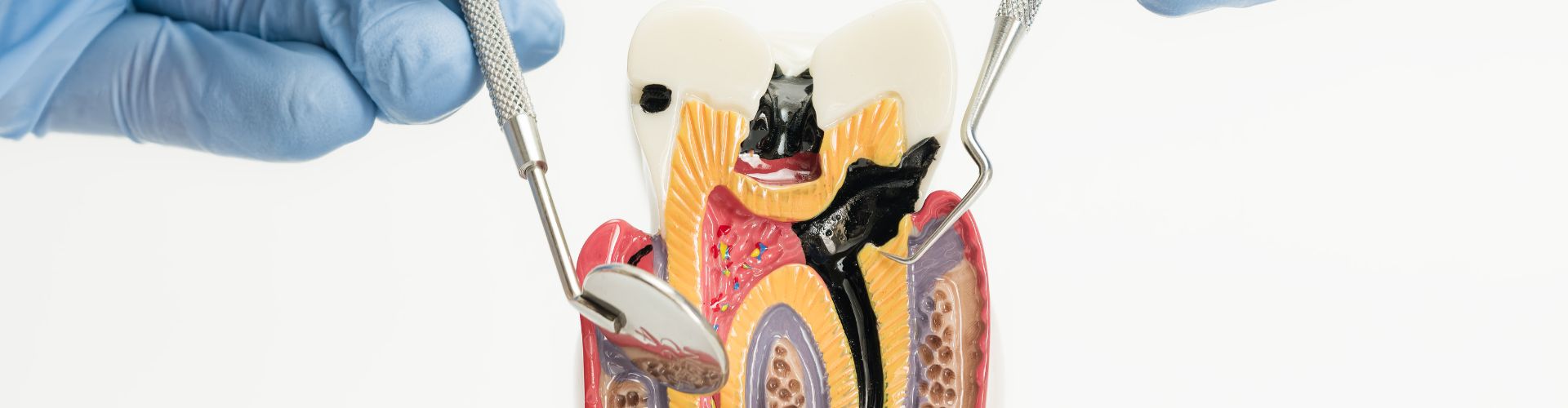 matar el nervio de una muela