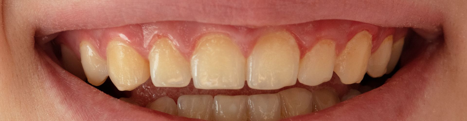 manchas blancas dientes