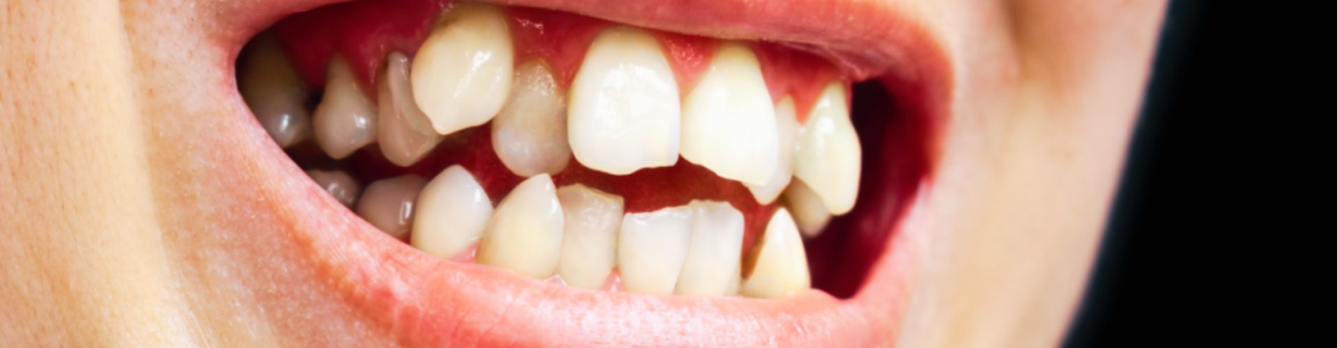 dientes caninos montados