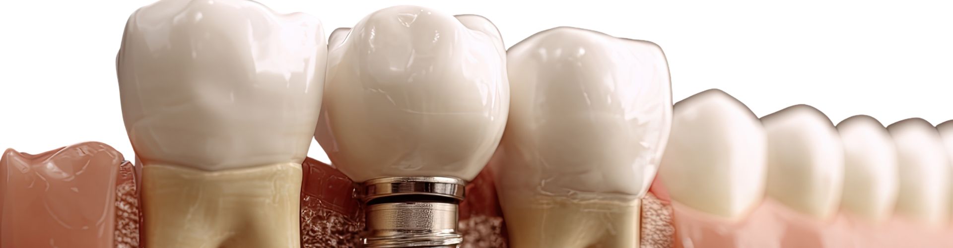 que puedo comer con implantes