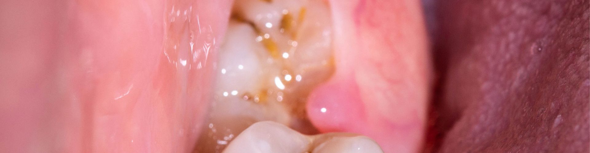 Necrosis ósea Maxilar