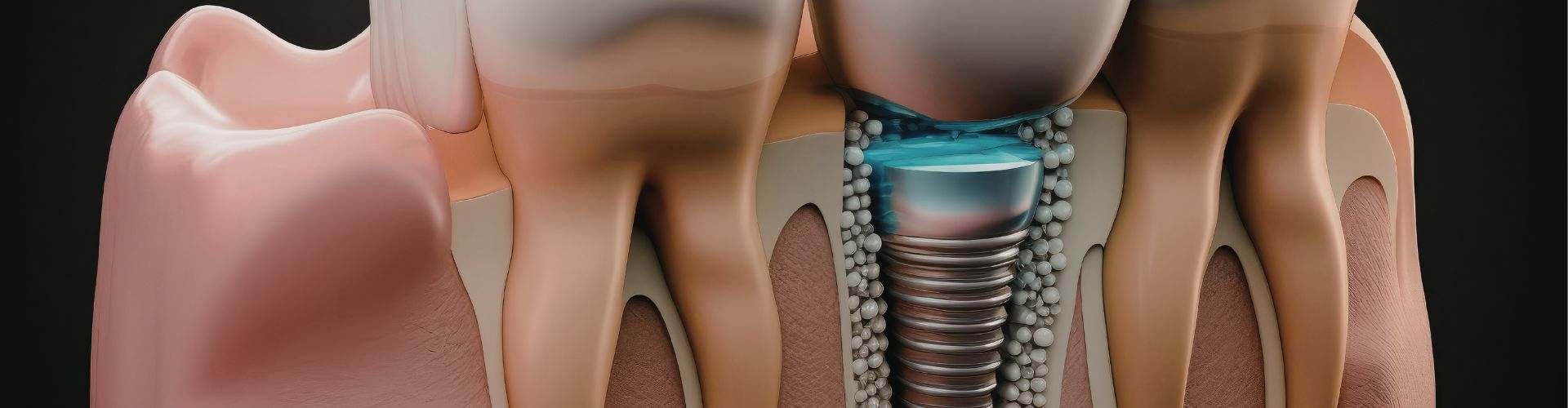 cuidados postoperatorios implantes dentales