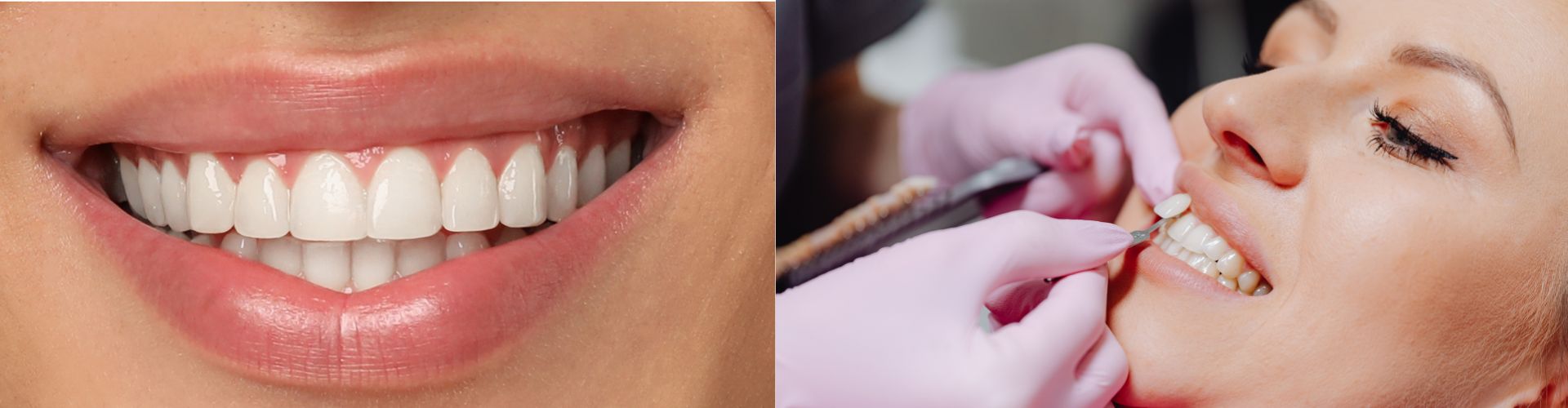 diferencias entre blanqueamiento dental y carillas