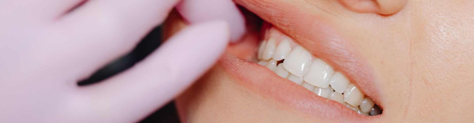 tratamientos para dientes desgastados